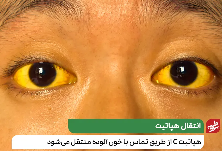 فردی که به دلیل ابتلا به هپاتیت C، پوست و چشمش زرد شده است|سیوطب
