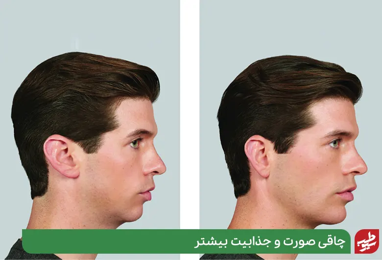 مردی قبل و بعد از چاقی صورت|سیوطب