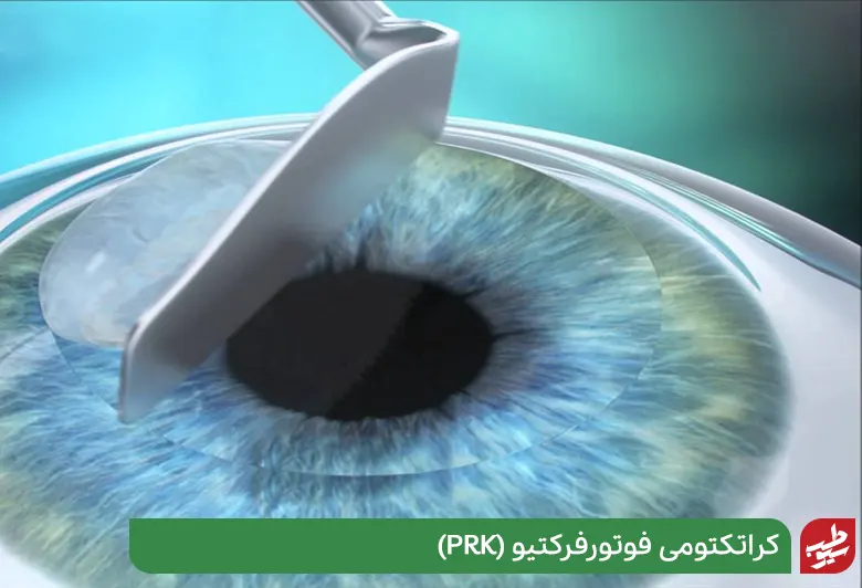 کراتکتومی فوتورفرکتیو (PRK) در درمان پیر چشمی|سیوطب