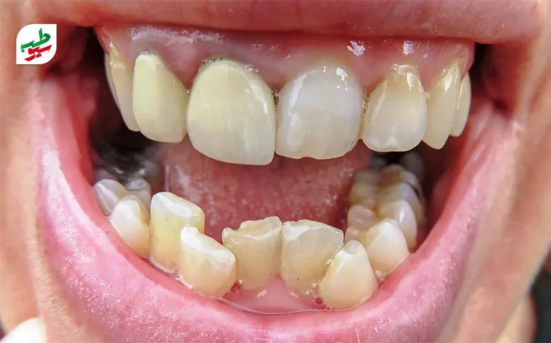 دندان‌های فردی که نیاز به ارتودنسی نامرئی دارد|سیوطب