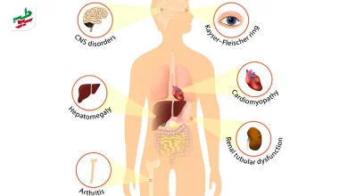 آناتومی بدن مرتبط با بیماری ویلسون|سیوطب