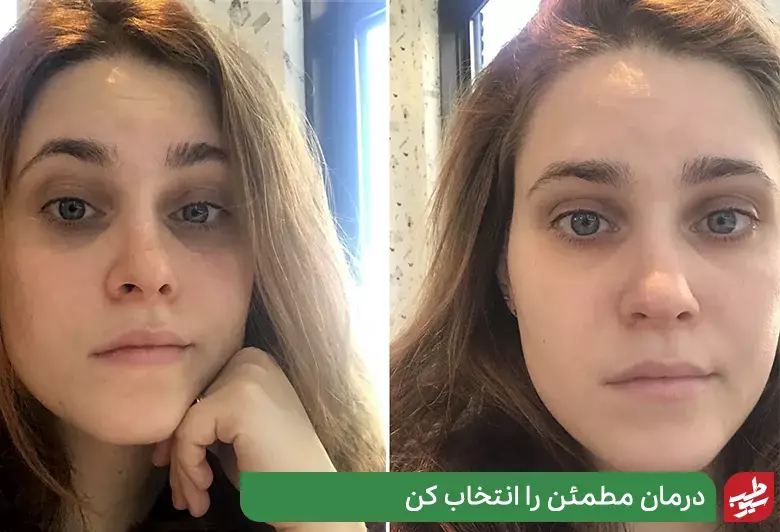 تصویر شخصی قبل و بعد از استفاده از ماسک خانگی چشم|سیوطب