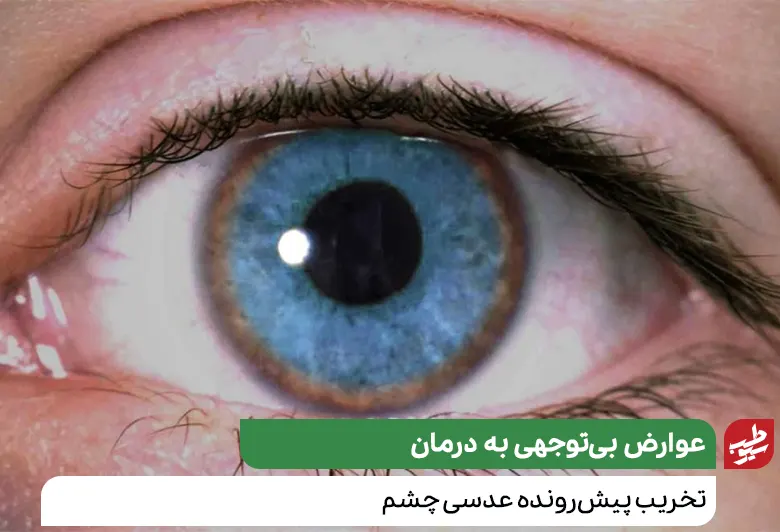 چشم یک بیمار مبتلا به بیماری ویلسون|سیوطب