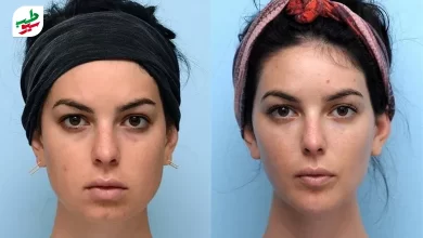 زنی قبل و بعد از چاقی صورت|سیوطب