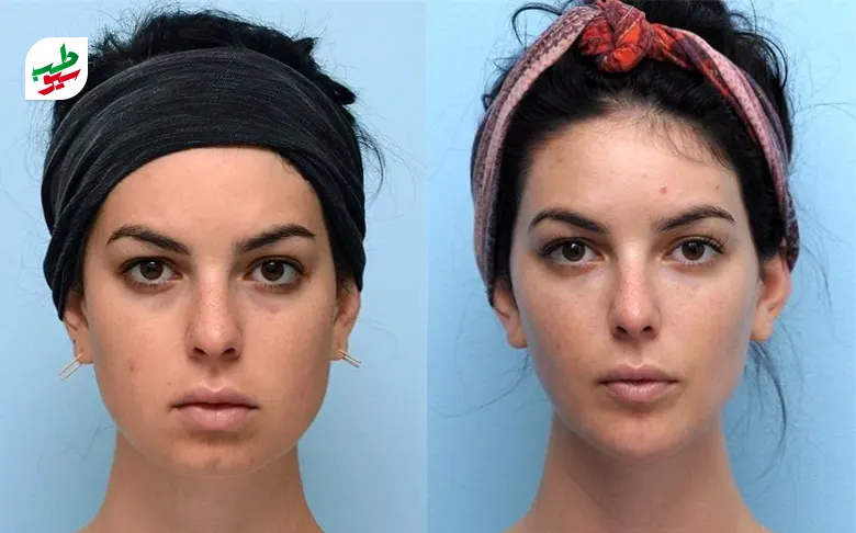 زنی قبل و بعد از چاقی صورت|سیوطب
