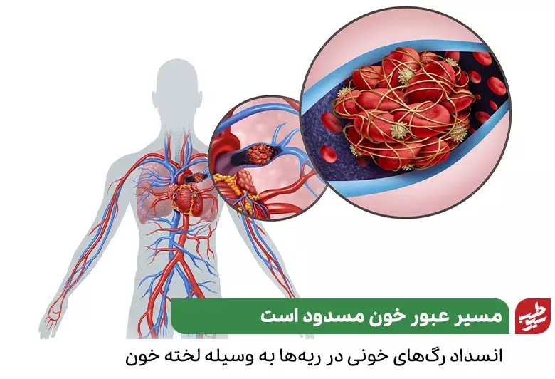 لخته خون مشخص شده در ریه و آمبولی ریه|سیوطب