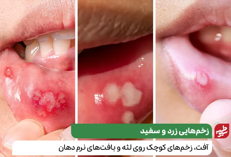 درمان آفت دهان با شناسایی انواع آن|سیوطب