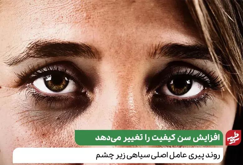 زنی که به دلیل نازکی پوست دور چشم نیاز به درمان سیاهی زیر چشم دارد|سیوطب