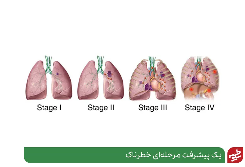 سرطان ریه مانند سایر سرطان‌ها 4 مرحله دارد|سیوطب