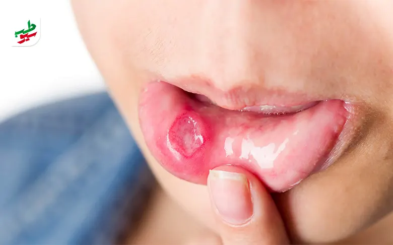 درمان آفت دهان|سیوطب