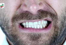 دندان قروچه به معنی فشار و ساییدن دندان‌ها روی هم است|سیوطب