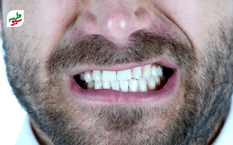 دندان قروچه به معنی فشار و ساییدن دندان‌ها روی هم است|سیوطب