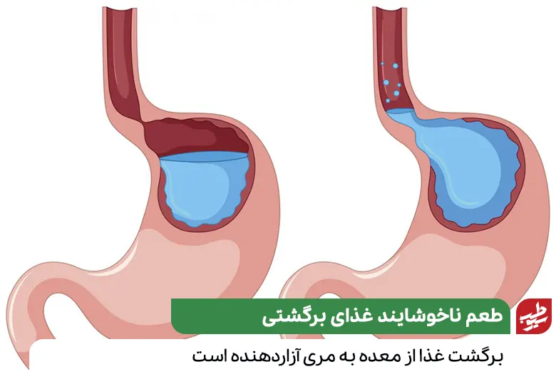 رفلاکس معده عامل ترش شدن دهان است|سیوطب