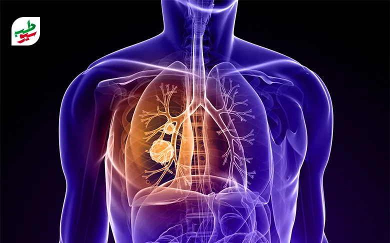 سرطان ریه که در بخشی از ریه مشخص شده است|سیوطب