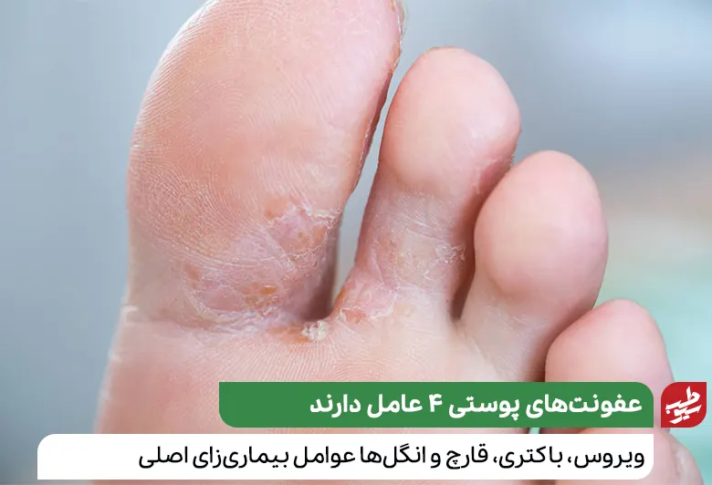 عفونت پوست از نوع قارچی در پاها|سیوطب
