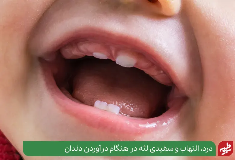 سفید شدن لثه در نوزادان به دلیل در آوردن دندان است|سیوطب
