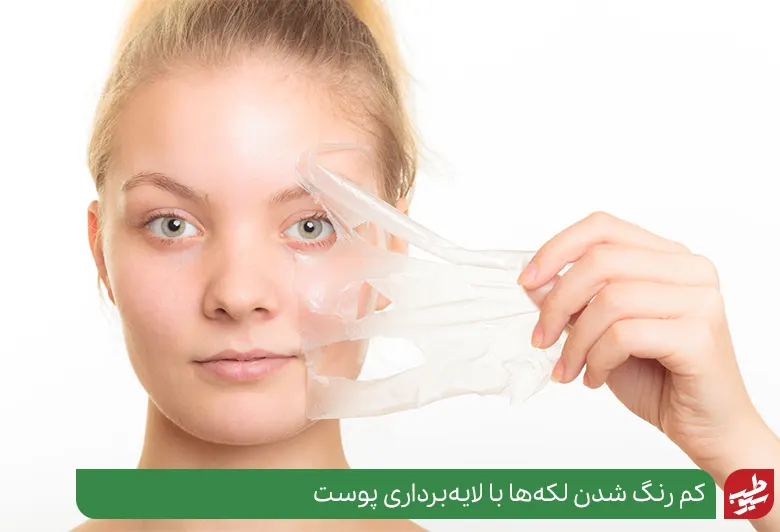 درمان تیرگی پوست دور دهان سیوطب