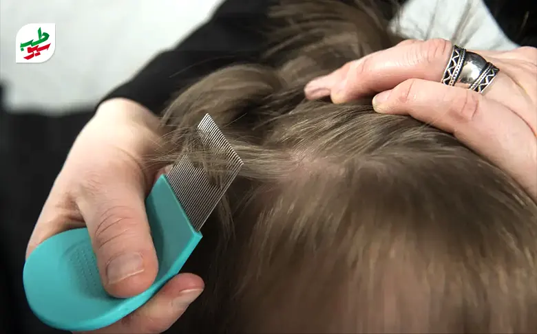 شانه زدن موها با شانه مخصوص برای درمان خانگی شپش سر|سیوطب