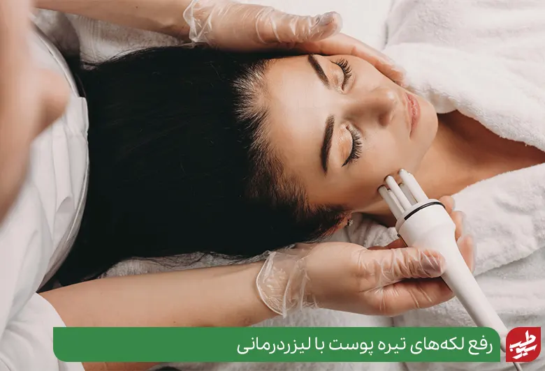 رفع لکه‌های تیره پوست با لیزردرمانی سیوطب