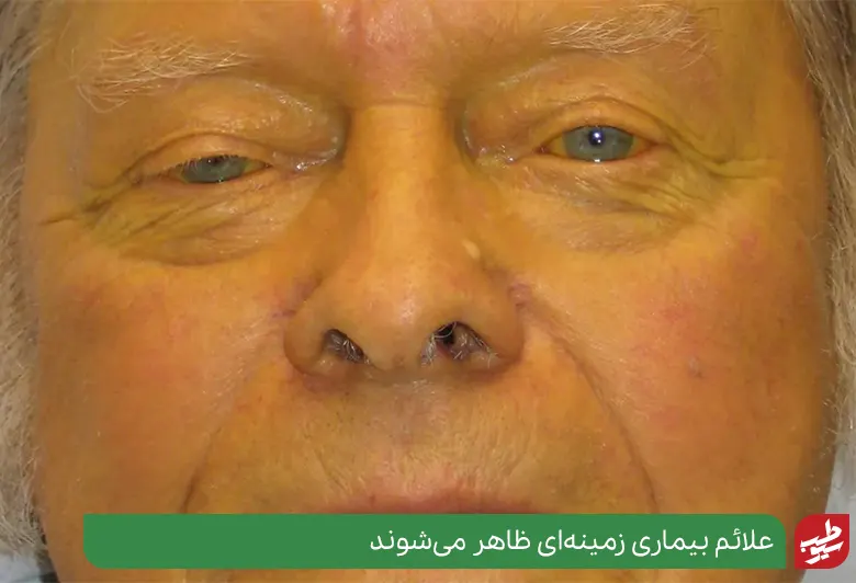 زردی عاملی برای زرد بودن سقف دهان است|سیوطب