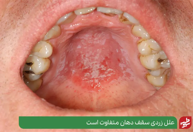 زرد بودن سقف دهان به دلیل برف دهان|سیوطب