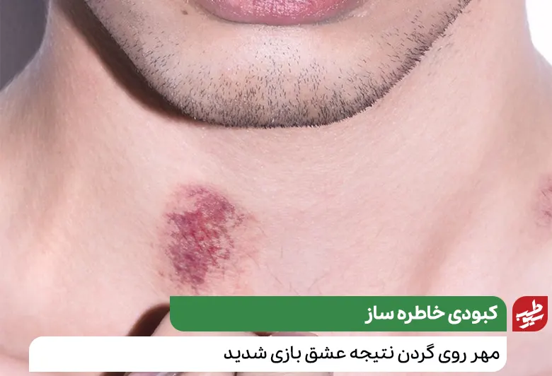 مردی که به درمان کبودی گردن نیاز دارد|سیوطب