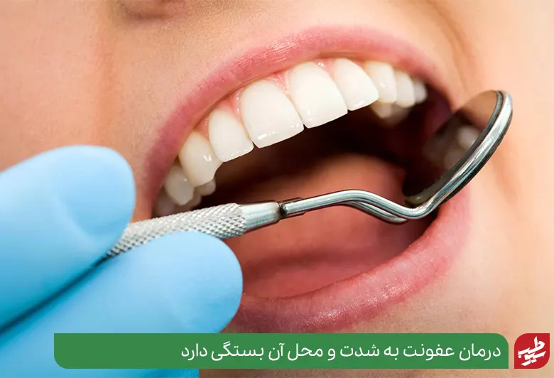 درمان عفونت دندان روکش شده به علت بستگی دارد|سیوطب