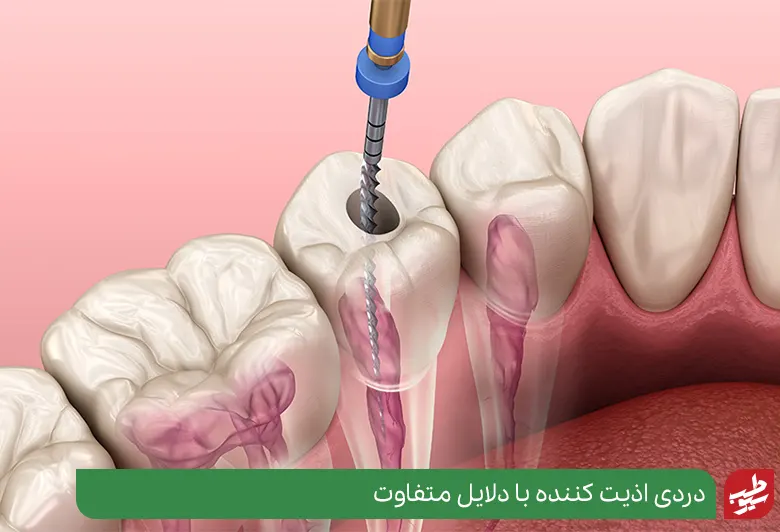 درمان دندان عصب کشی شده به علت آن بستگی دارد|سیوطب