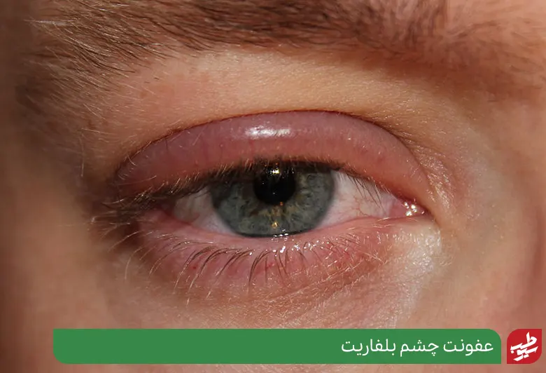 عفونت چشم بلفاریت|سیوطب