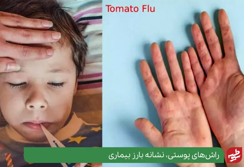  کودکی مبتلا به آنفولانزای گوجه فرنگی|سیوطب