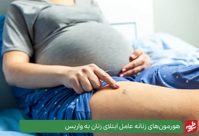 زن بارداری که دچار واریس شده و نیاز به درمان خانگی واریس پا دارد|سیوطب