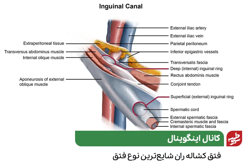 آناتومی کانال اینگوینال و عضلات جانبی آن که به جراحی فتق بیضه نیاز دارد|سیوطب
