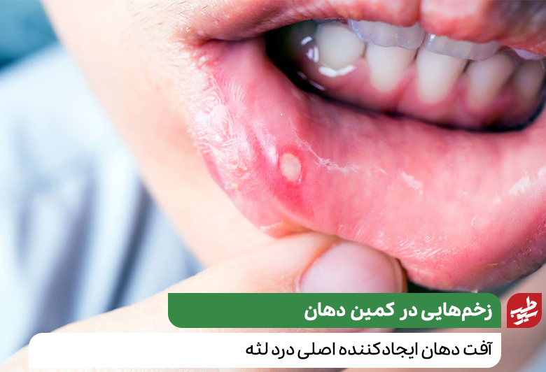 آفت دهان که نیاز به درمان خانگی درد لثه دارد|سیوطب