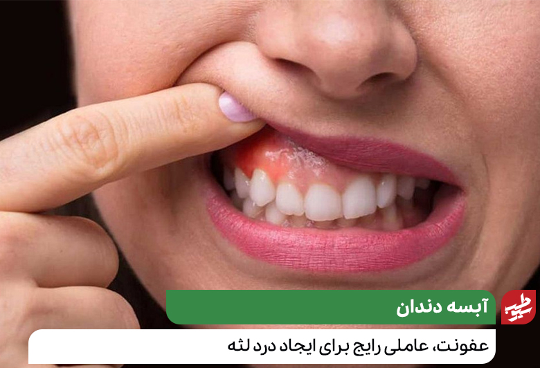 آبسه دندان که نیاز به درمان خانگی درد لثه دارد|سیوطب