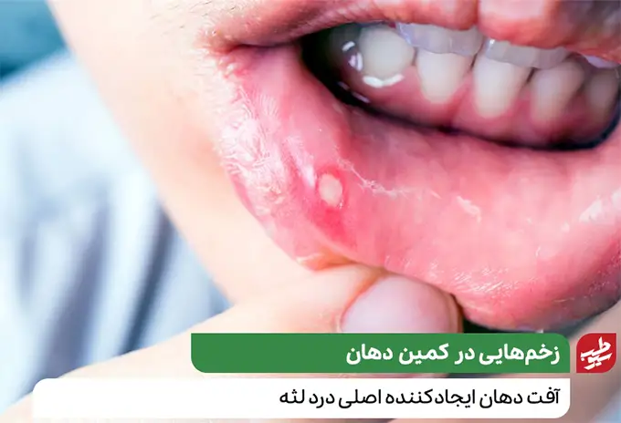 آفت دهان (زخم دهان) منشایی برای بروز درد لثه