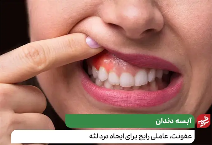  درد لثه نشات گرفته از آبسه دندان