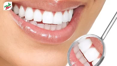 عفونت دندان روکش شده با نگهداری و مراقبت درست قابل پیشگیری است|سیوطب