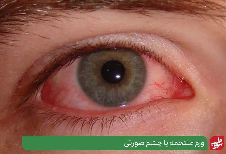 عفونت چشم صورتی یا ورم ملتحمه|سیوطب
