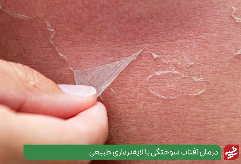 لایه‌برداری پوست و درمان آفتاب سوختگی|سیوطب