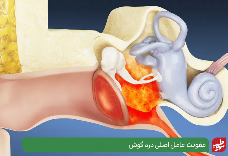 آناتومی گوش که دچار عفونت شده و نیاز به درمان خانگی عفونت گوش دارد|سیوطب