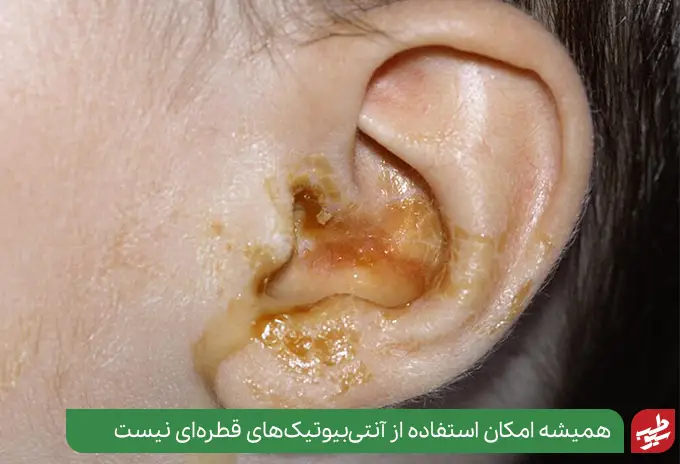 بهترین آنتی بیوتیک برای عفونت گوش را نمی‌توان در عفونت شدید به گوش تزریق کرد|سیوطب