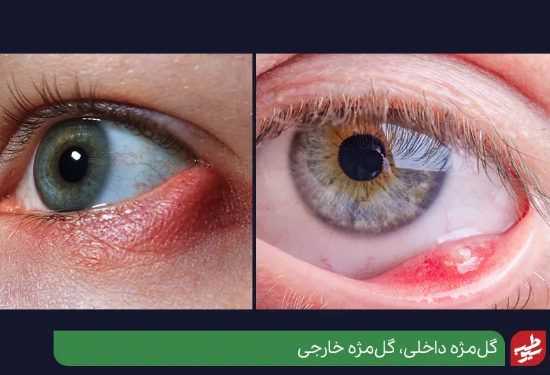 سریعترین درمان گل مژه خارجی و داخلی چشم|سیوطب