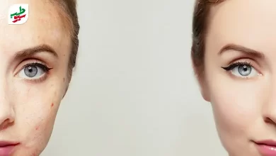 صورت فردی قبل و بعد از درمان خانگی جوش صورت|سیوطب