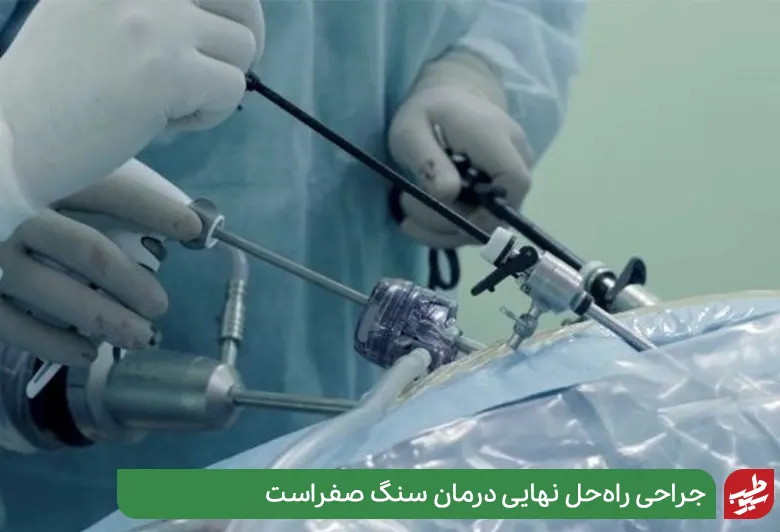 چه اندازه سنگ صفرا نیاز به جراحی دارد از نوع سیستکتومی لاپارسکوپی|سیوطب