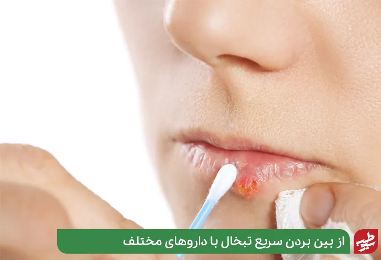 رفع تبخال در سه دقیقه با داروهای مختلف|سیوطب