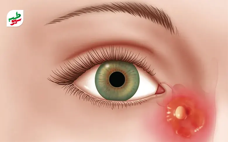 فردی مبتلا به گل مژه چشم که باید سراغ سریعترین درمان گل مژه برود|سیوطب