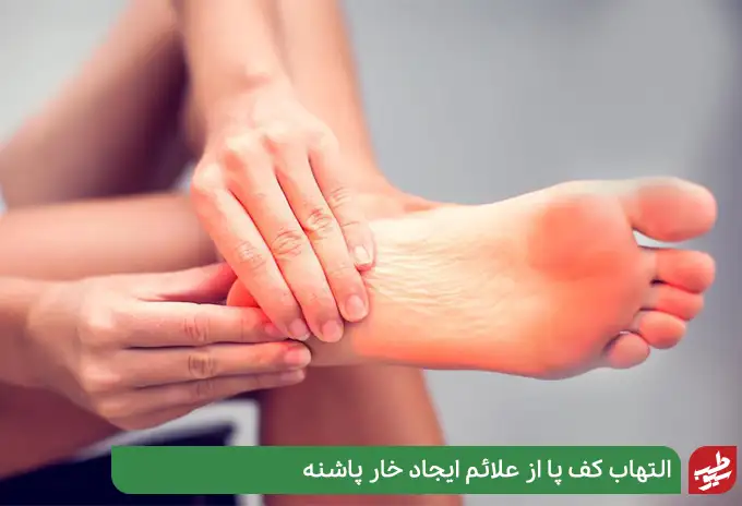 التهاب کف پا از علائم ایجاد خار پاشنه|سیوطب