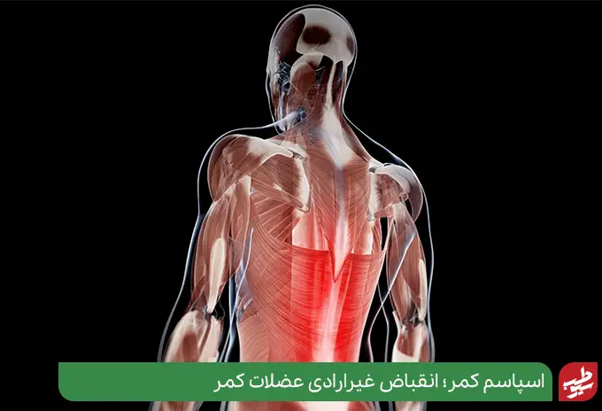 گرفتگی عضلات یا اسپاسم کمر|سیوطب