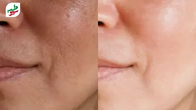 قبل و بعد از بستن دائم منافذ پوست صورت|سیوطب