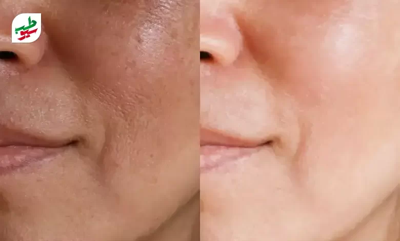 قبل و بعد از بستن دائم منافذ پوست صورت|سیوطب